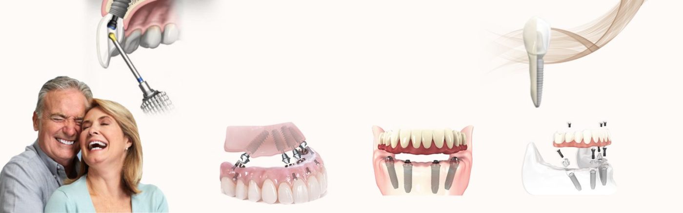 DENTAL IMPLANTS ( Master in the field of Implantology since 14 years )