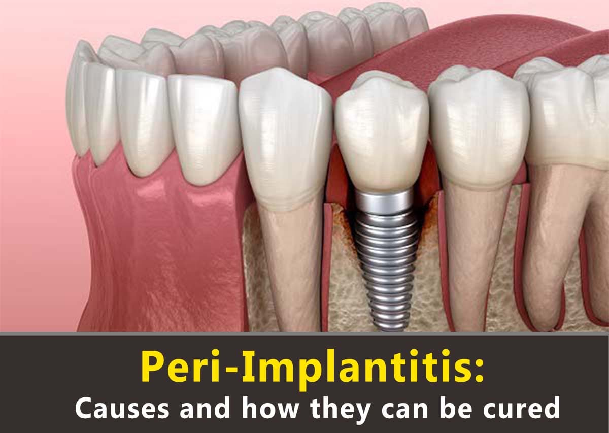 Peri-Implantitis: Causes And How They Can Be Cured – Dr Bhimani