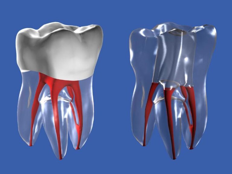 Single Visit Root Canal Treatment